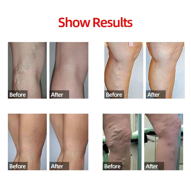 1 par de mangas de compresión para pantorrilla, calcetines de compresión para pierna para correr, férula para espinilleras, para hombres y mujeres, 20-30mmHg